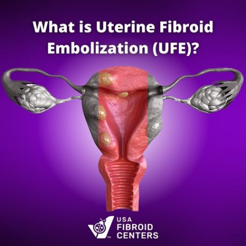 What-is-Uterine-Fibroid-Embolization.jpg