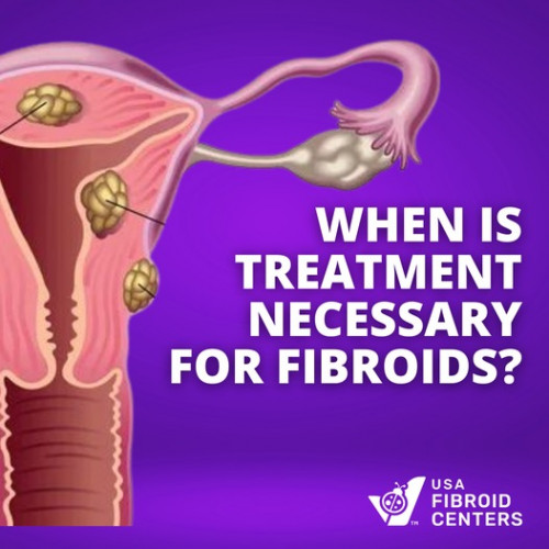 When-Treatment-is-necessary-For-Fibroid.jpg