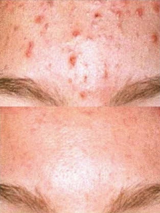 actinic-keratosis.jpg