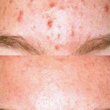 actinic-keratosis