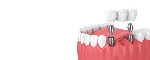 A dental implant is a surgical process, and in this process, a metal frame is being inserted inside your jawbone and then screws it up. This metal framework as the root of the artificial tooth and also supports adjacent teeth. We offer dental implants in Perris, CA. Visit for more details:https://nuevoperrisdental.com/services/dental-implants-perris-ca/