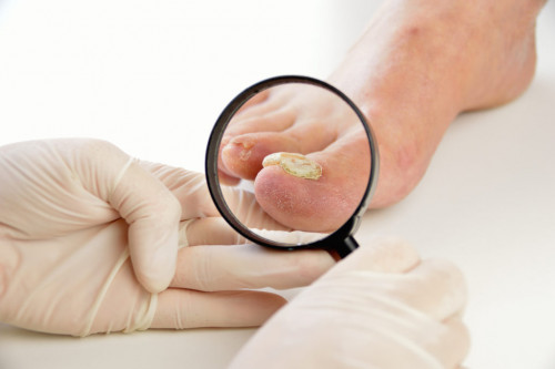Do you Know Onychomycosis is also known as fungal nail infection? Onychomycosis can cause pain, discomfort, and disfigurement and may produce serious physical. Here we explain the top 3 over counter treatment for Onychomycosis. To know more details, read this blog.