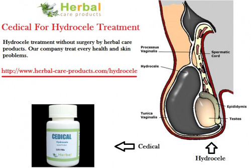 Natural Remedies for Hydrocele and herbs for Hydrocele are effective to reduce the swelling in your scrotum. Herbal Treatment for Hydrocele reduce the pain and swelling in scrotum. Herbal Product name as “CEDICAL” is helpful for hydrocele with smarting, burning type of pain.

https://www.herbal-care-products.com/blog/10-natural-remedies-for-hydrocele/