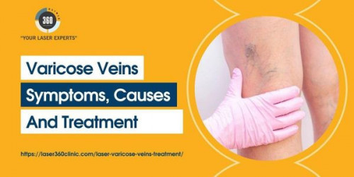 Laser treatments for varicose veins are quite important for getting healed at a faster pace. Laser surgery has a higher success rate as compared to traditional methods of surgery.
https://laser360clinic.com/varicose-veins-symptoms-causes-and-treatment/