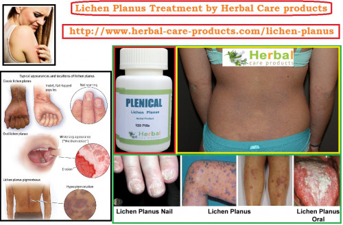 Herbal Treatment for Lichen Planus helpful in relieving itching and improving the appearance of the rash until it goes away. The goal of treatment is reduce your symptoms and speeds healing of skin.

https://www.herbal-care-products.com/blog/10-natural-remedies-for-lichen-planus/