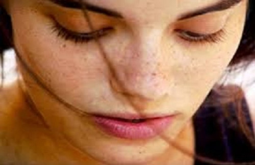 melasma-young.jpg