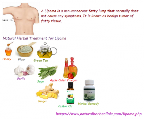 Ginger is one of the useful herbal ingredients which use in Herbal Treatment for Lipoma. that can effectively help lessen the size of lipomas... https://naturalcureproducts.wordpress.com/2018/07/26/natural-herbal-treatment-for-lipoma/