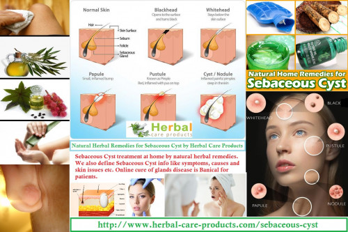 Herbal Treatment for Sebaceous Cyst the infected ones, also focus upon using natural ingredients that have anti-bacterial properties and such other properties that diminish swelling... and further discomfort caused by infections of cysts. Herbal Care Products are offering “BANICAL”, an Herbal Product made out of 100% natural herbs. It has been specially formulated for patients suffering from Sebaceous Cyst. This Herbal Treatment for sebaceous cyst is helpful in reduce the growth.

https://www.herbal-care-products.com/blog/sebaceous-cyst-natural-herbal-remedies-for-skin-glands/