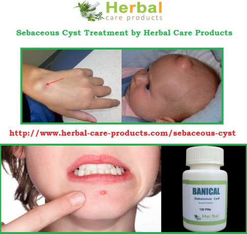 Natural Remedies for Sebaceous Cysts that you can try to use to remove or reduce sebaceous cyst. Herbal Treatment for Sebaceous Cyst to cure a non-painful sebaceous cyst.

https://www.herbal-care-products.com/sebaceous-cyst

https://herbalcareproductstreatment.wordpress.com/2015/02/27/sebaceous-cyst-symptoms-treatment-natural-herbal-product/