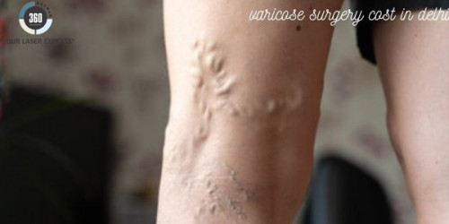 Laser varicose veins removal has been promised to be healed at a quite faster pace and at affordable rates by us.
https://laser360clinic.com/laser-varicose-veins-treatment/