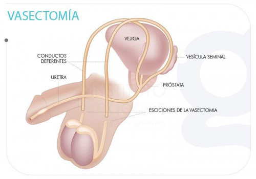 vasectomia-grafico-1.jpg